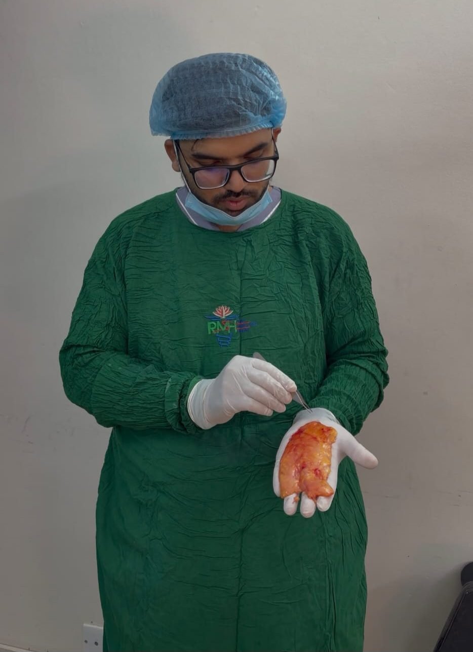 Dr. Khaled Hasan Milu holding a large fat lobule from inside a lipoma tumour