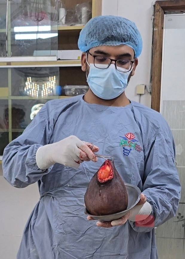 Dr. Khaled Hasan Milu holding a large pendulous lipoma tumour after its removal