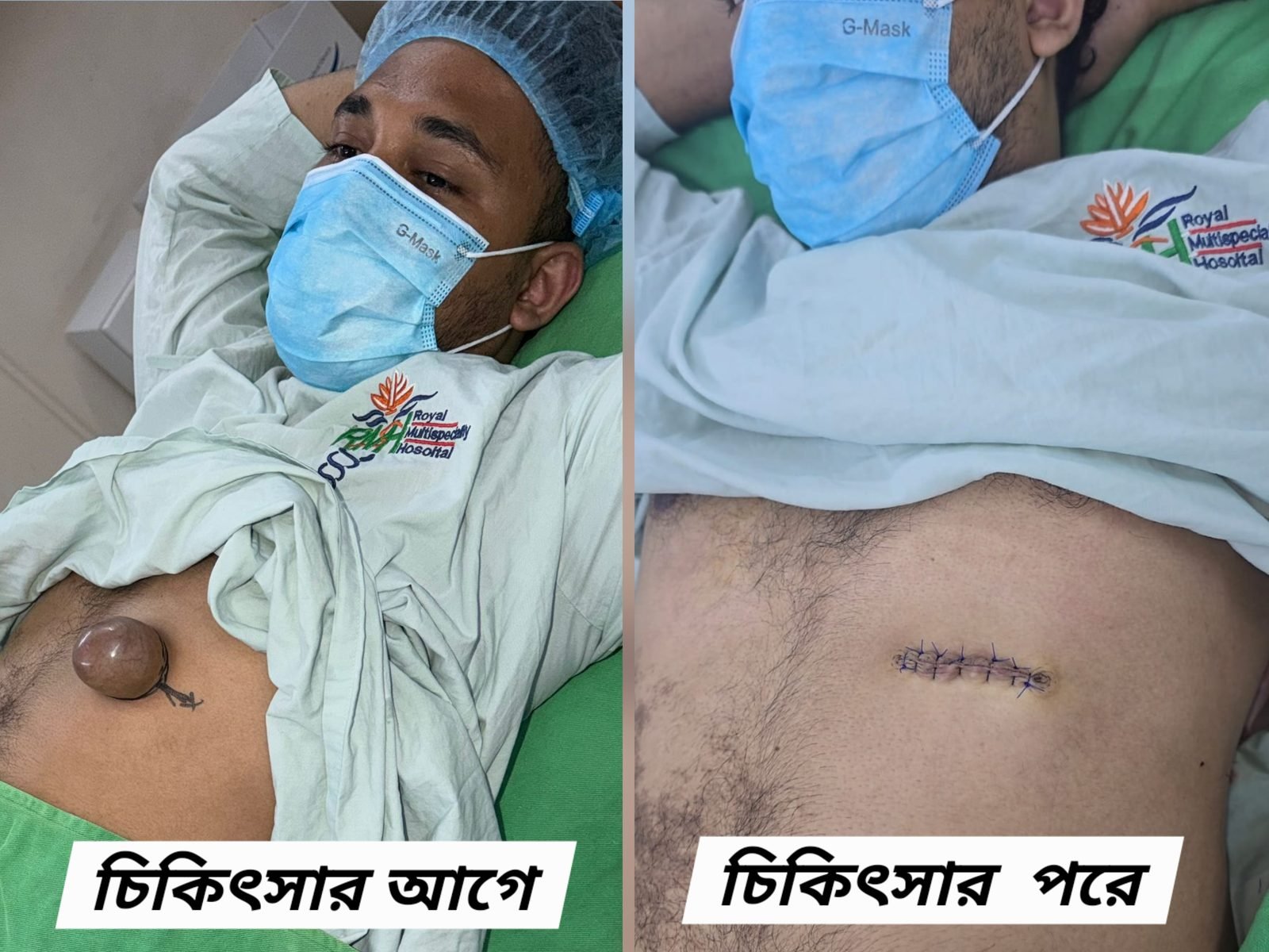 Large abdominal epidermal inclusion cyst — before and after removal