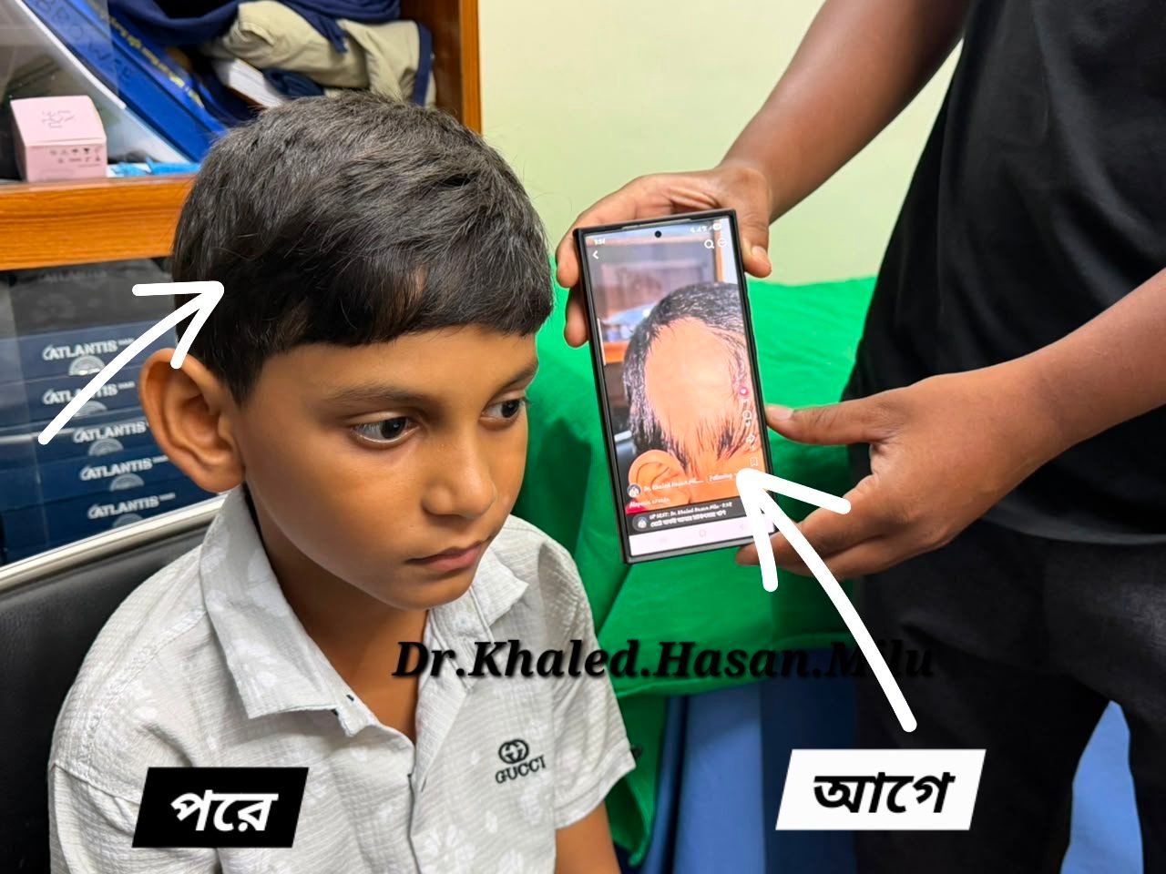 A child's alopecia areata hair loss — before and after therapy