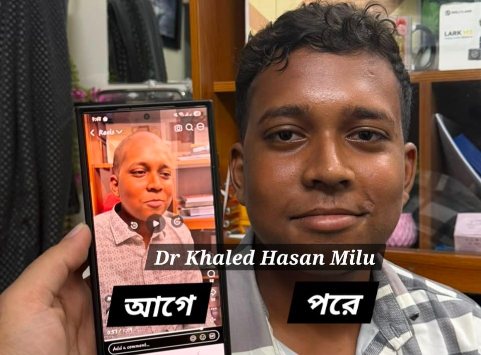 Alopecia universalis — complete hair loss before and after treatment