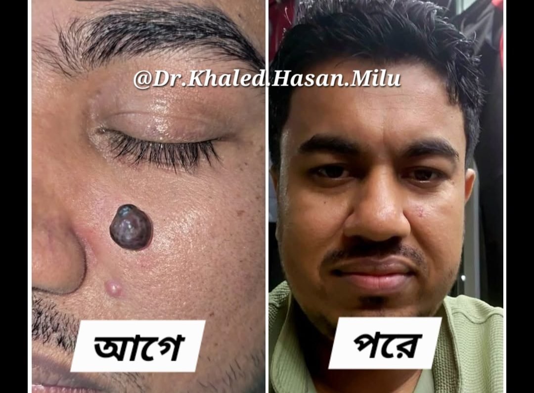 Cheek mole removed with laser — before and after