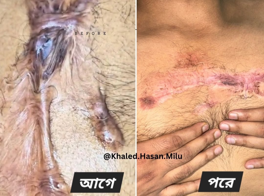 Chest keloid — before and after treatment