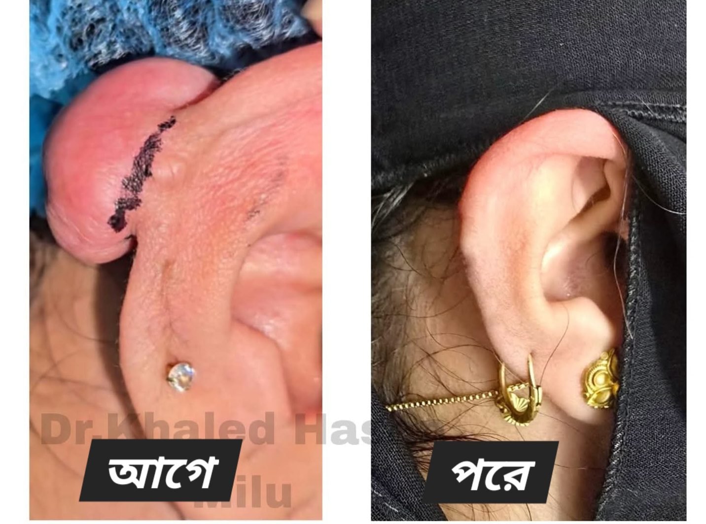 Ear keloid — before and after removal