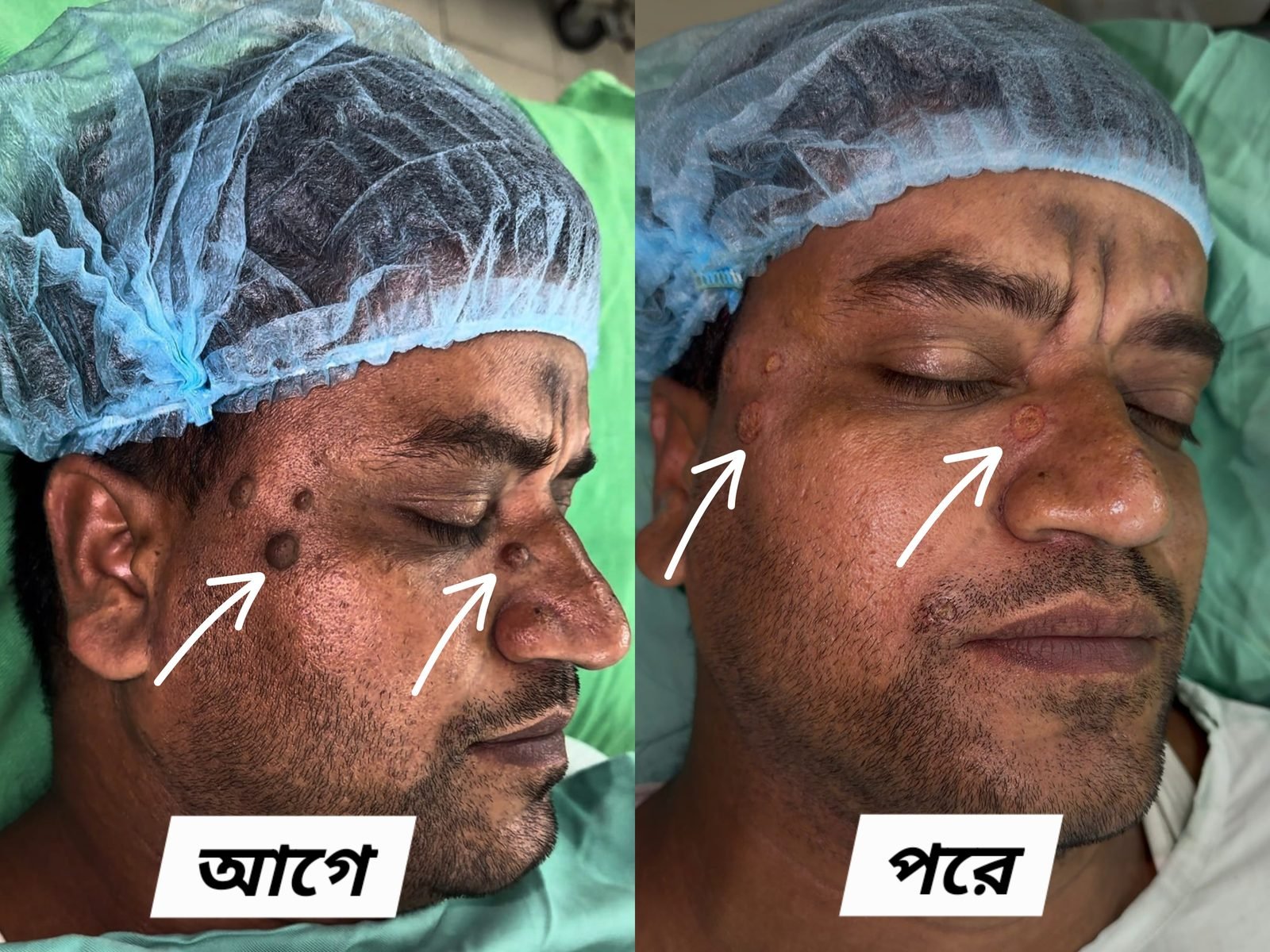 Facial mole removed with laser — before and after