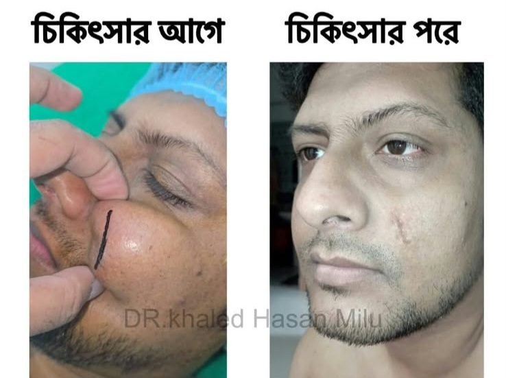 Giant facial cyst — before and after removal