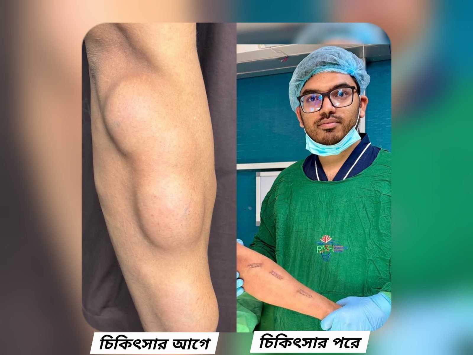 Multiple large lipoma tumours on the hand — before and after removal