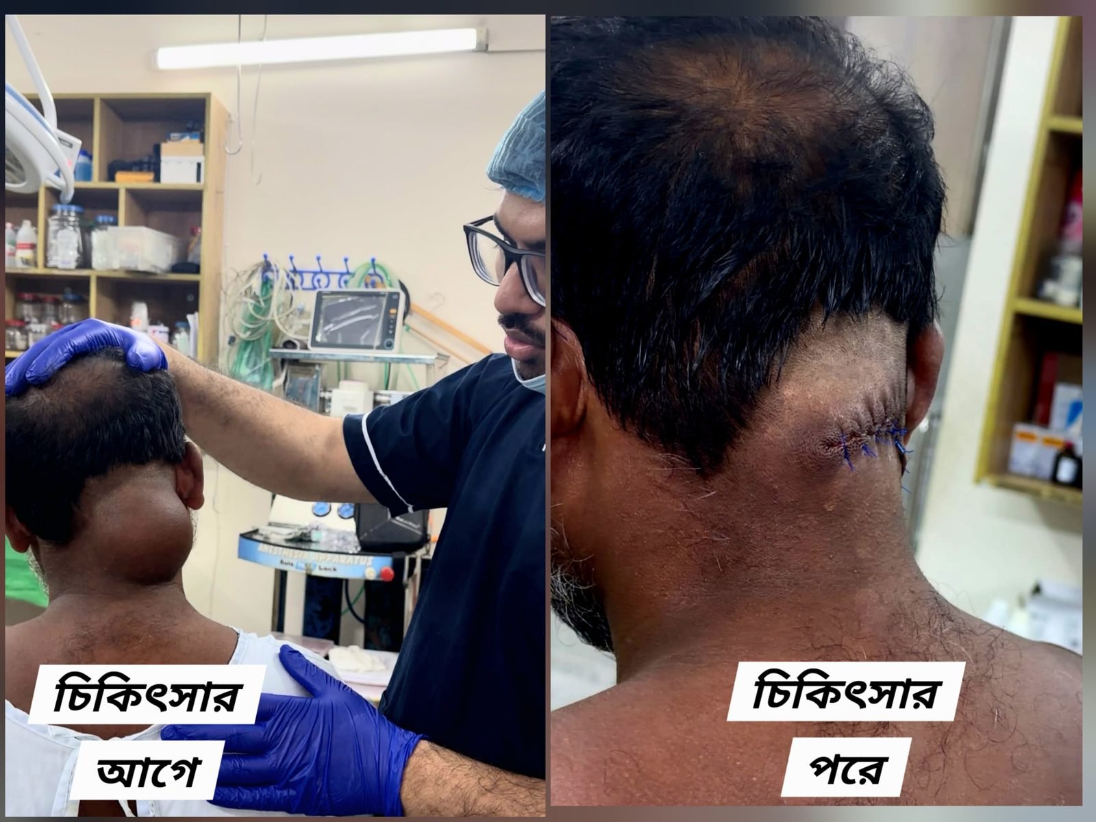 Large lipoma at the back of the neck — before and after removal