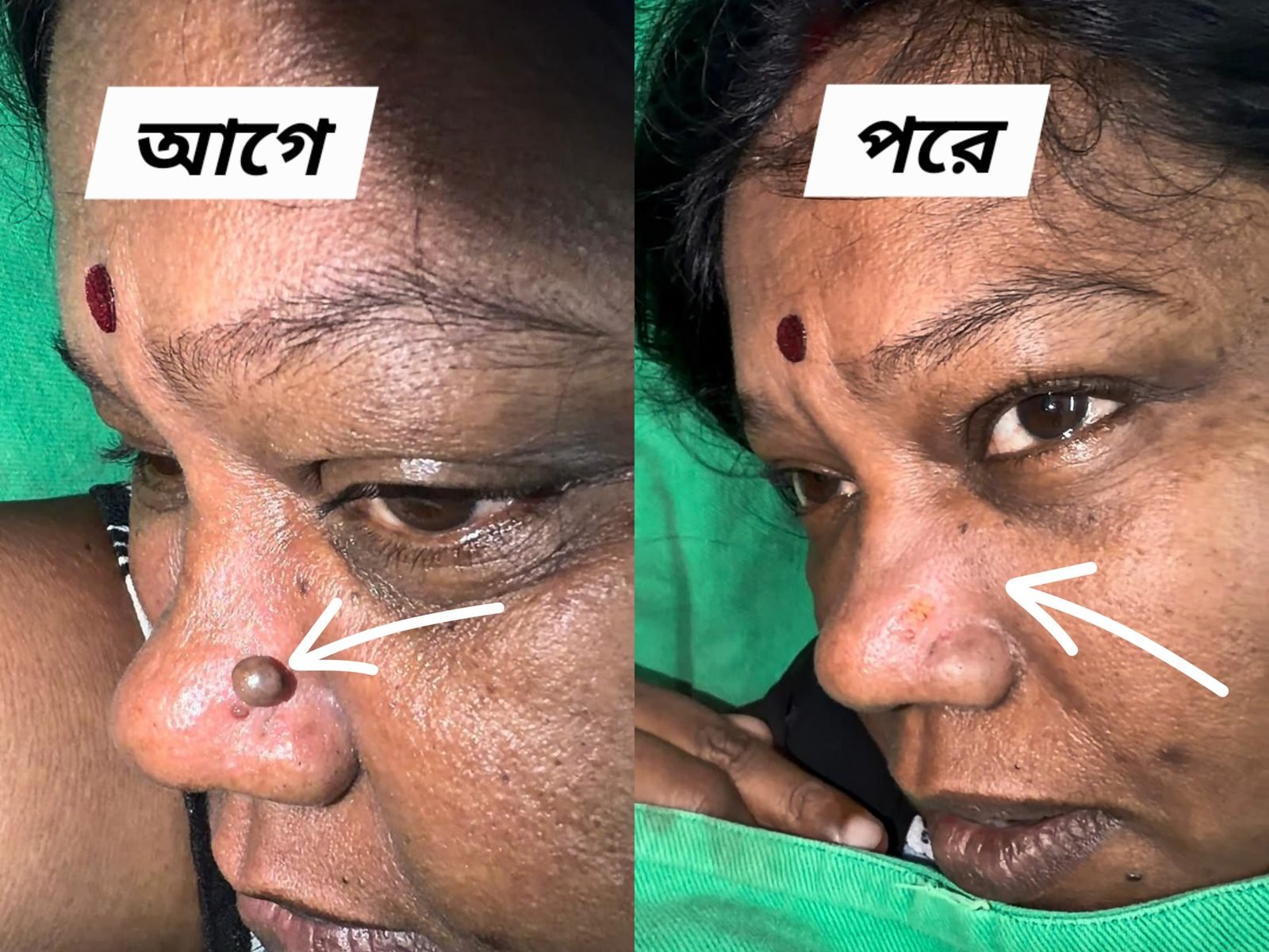 Nose mole removed with laser — before and after