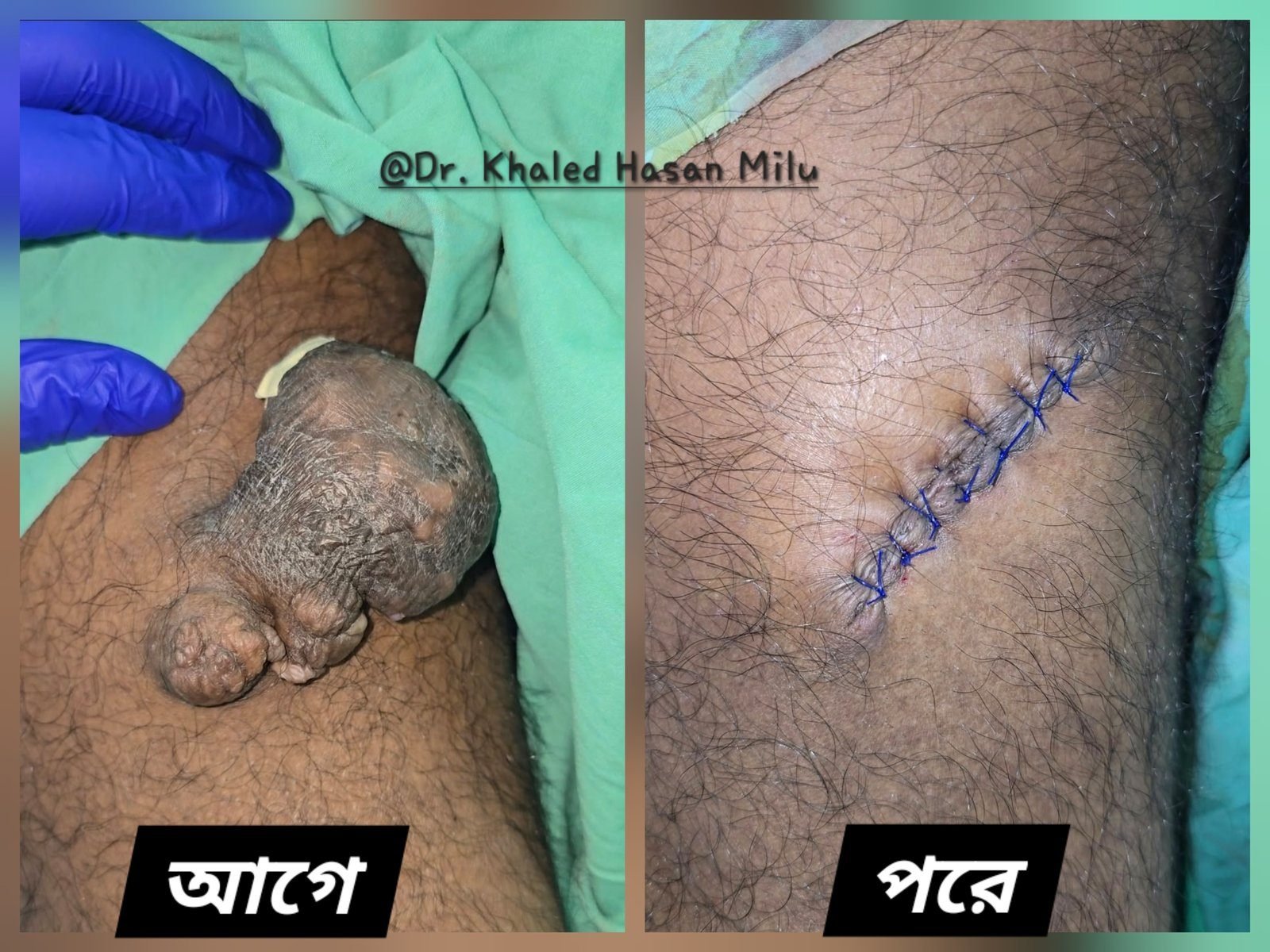 Pedunculated fibrolipoma tumour — before and after removal