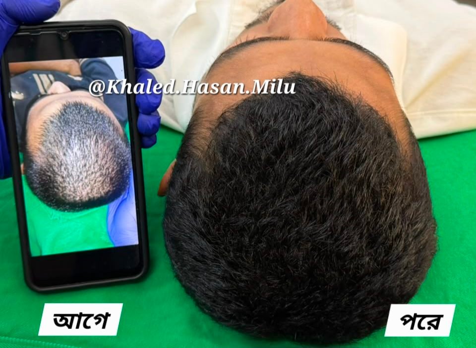 Dense hair regrowth at the crown after PRP therapy — before and after