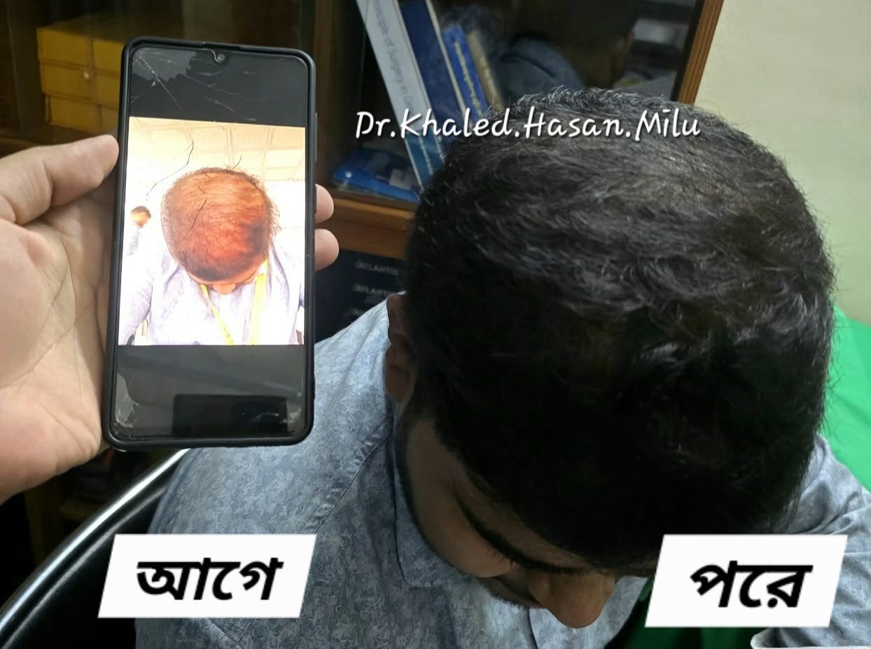 Dense hair regrowth after PRP and Exosome therapy — before and after