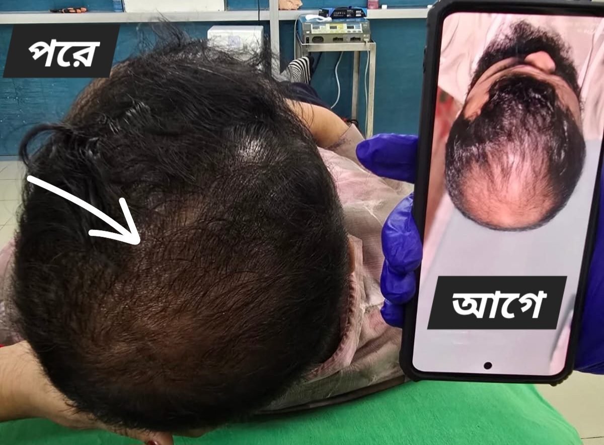 Hair regrowth after PRP therapy — before and after