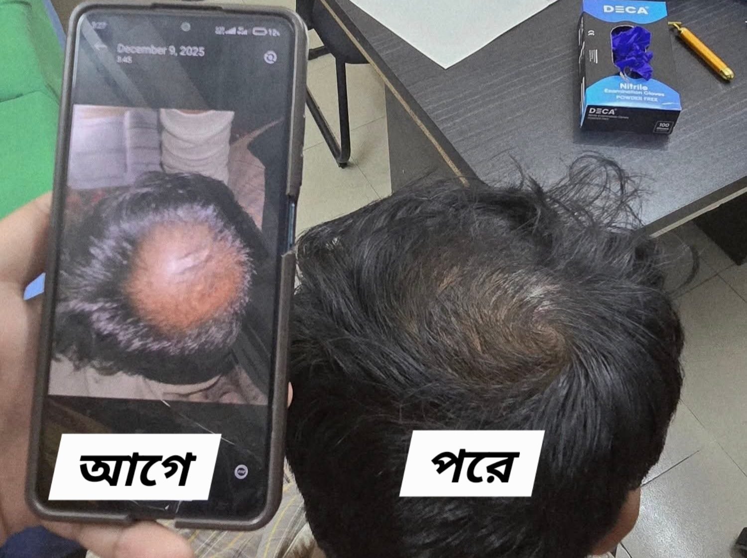 Hair regrowth after PRP therapy — before and after