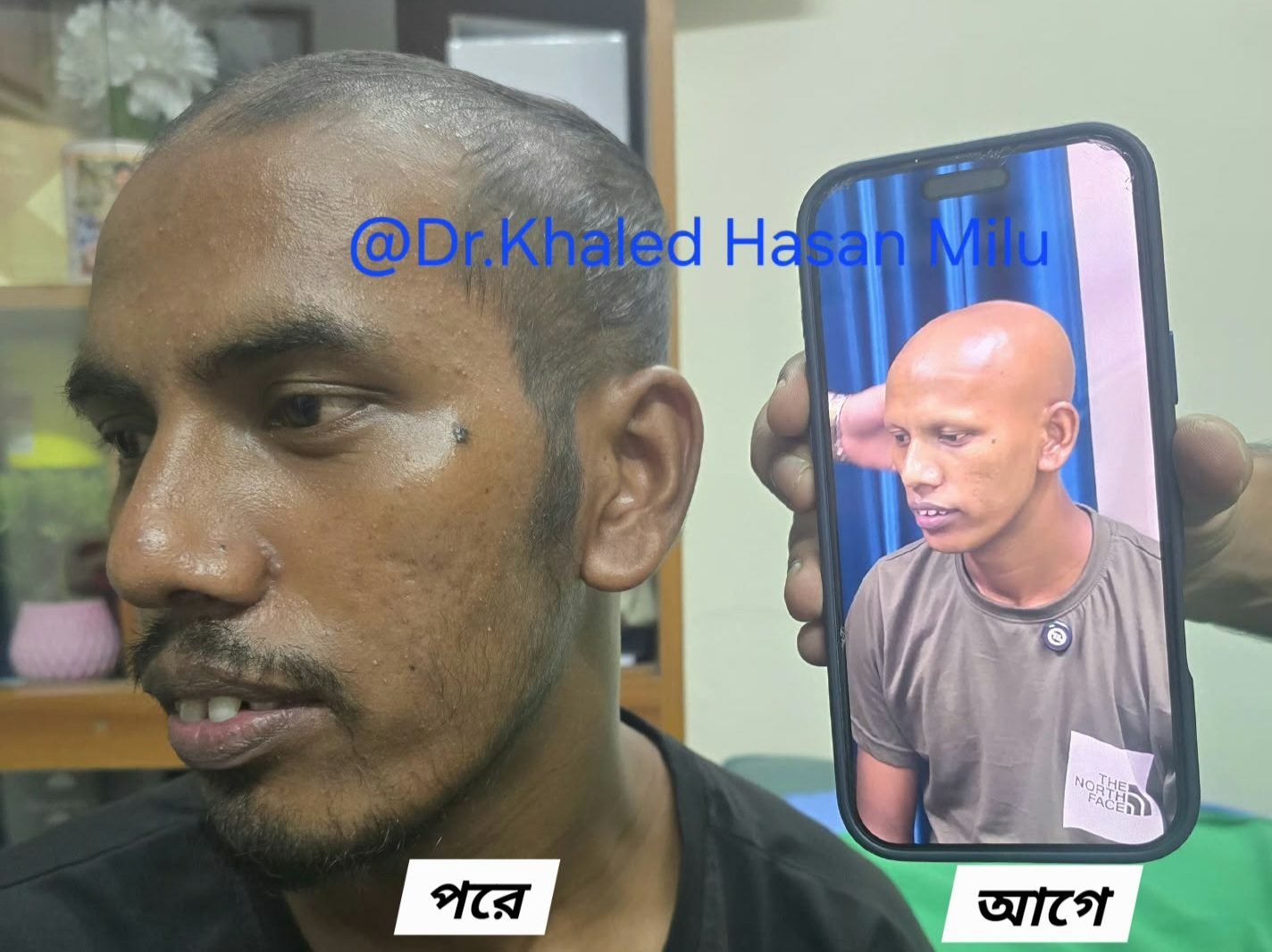 Hair regrowth after PRP therapy — before and after