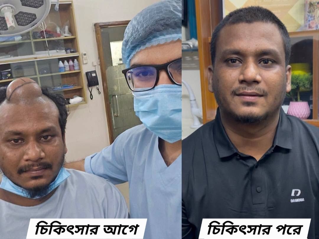 Large scalp tumour — before and after removal