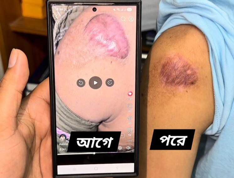 Shoulder keloid — before and after removal